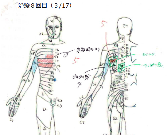 【治療8回目】3月17日